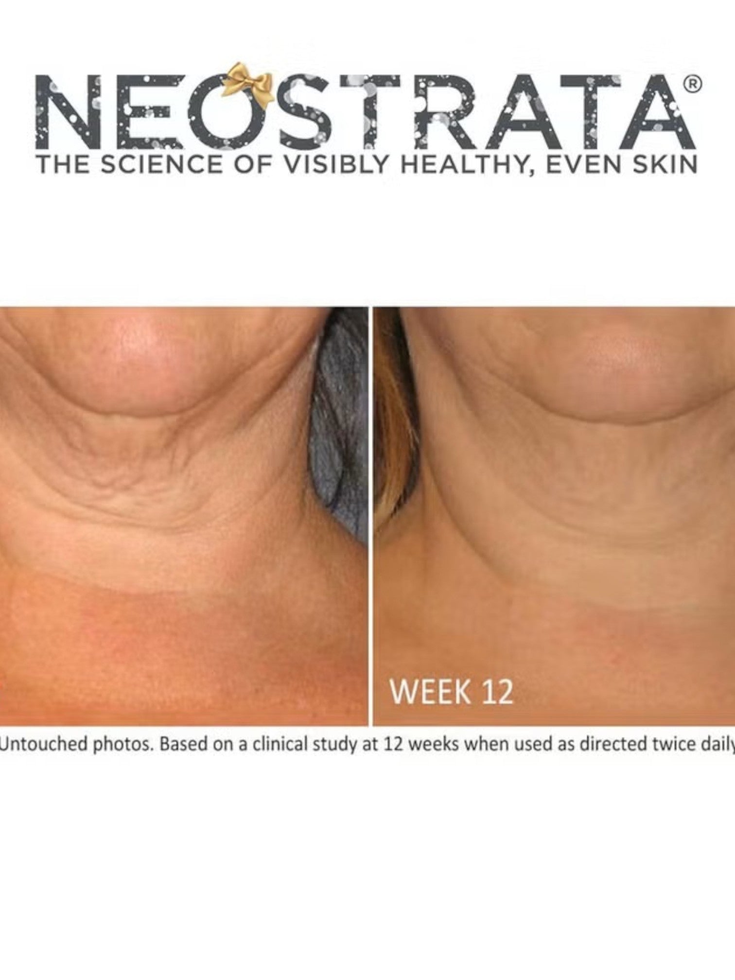 Neostrata advertisement showing before and after effects on skin, labeled Week 12. Neostrata, Monza Outlet, Monza Fashion, Shein Outlet